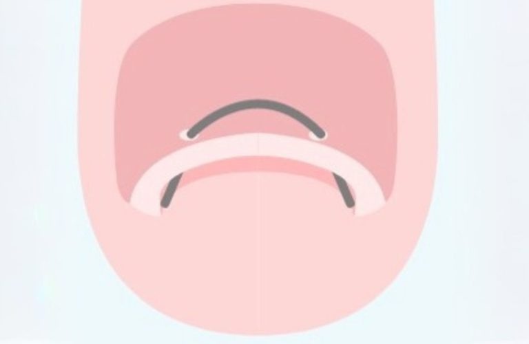 弾性ワイヤー法